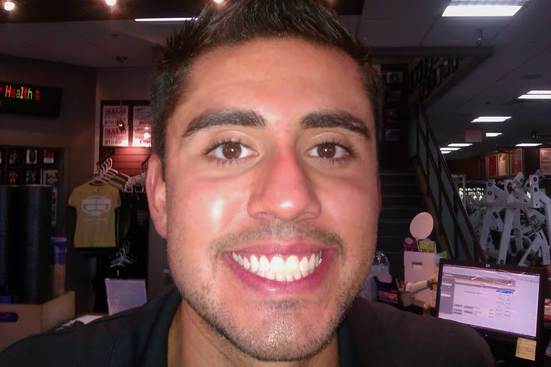 After Teeth Whitening teeth whitening after